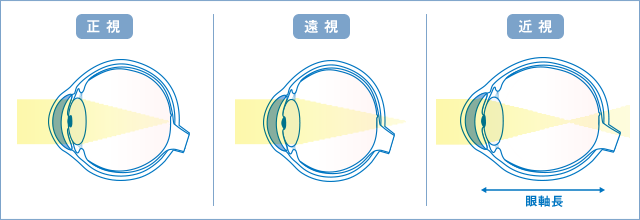 近視と眼軸長の図